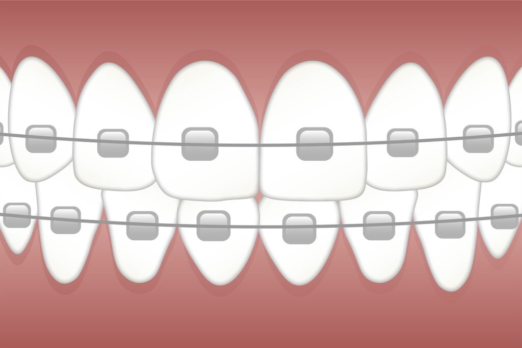 How to care for your teeth after getting a dental bridge supported denture