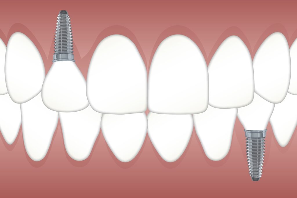 How to maintain dental health with a root canal treatment