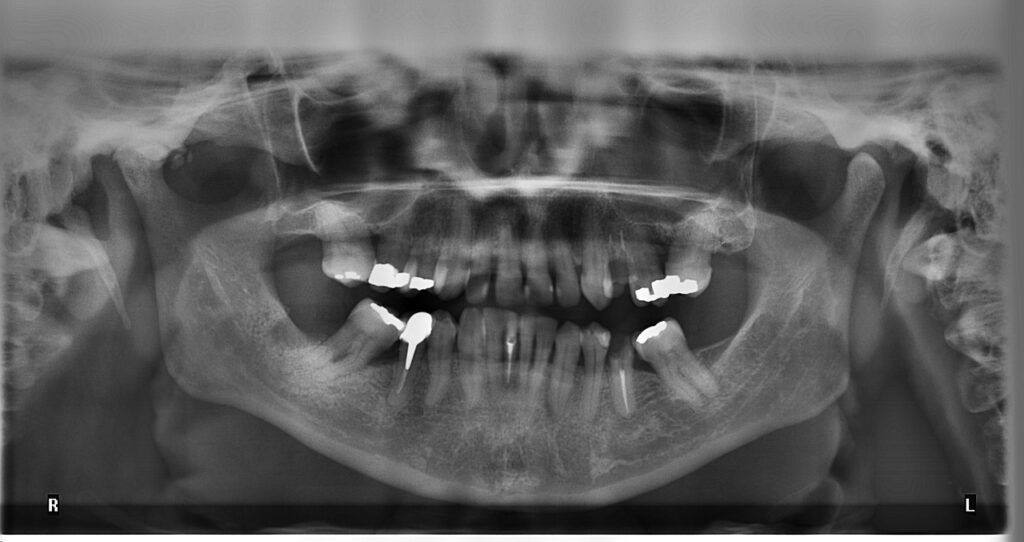 The role of dental X rays in detecting and treating cavities