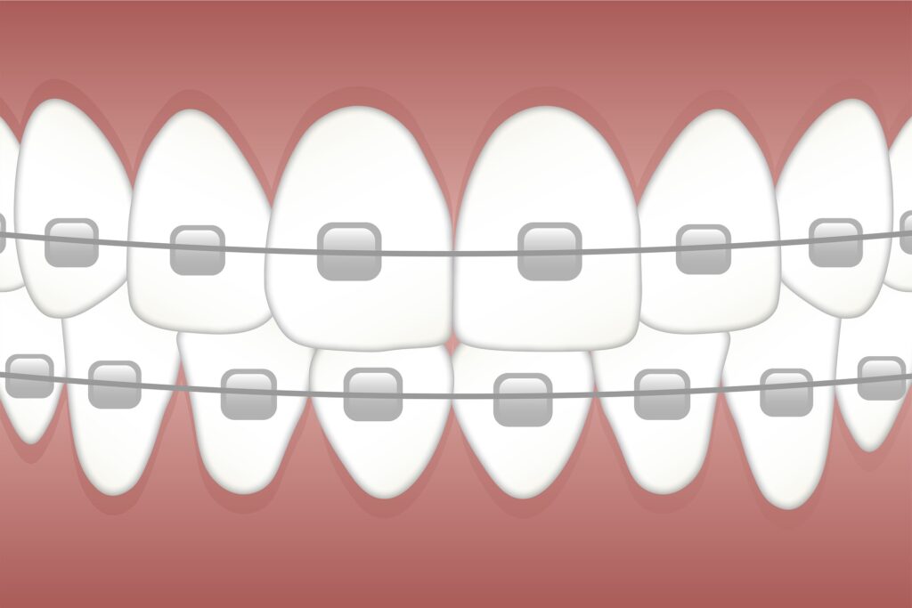 The role of dental braces in maintaining dental health