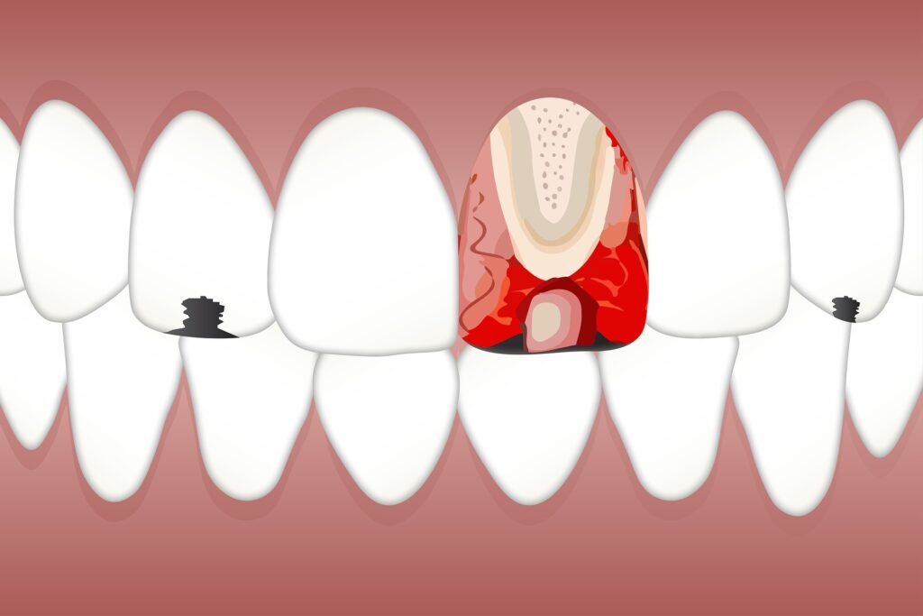 The Different Stages of Tooth Decay From Enamel Erosion to Cavity Formation