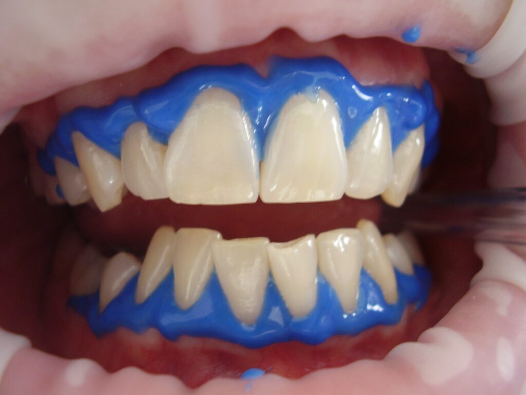 Medications and their impact on the success of teeth whitening for patients with sensitive teeth