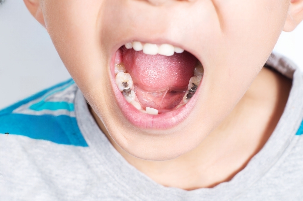 How to prevent and treat cavities in children