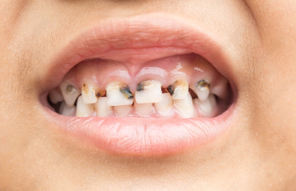 The Benefits of Vitamin B9 Folate for Preventing Gingivitis