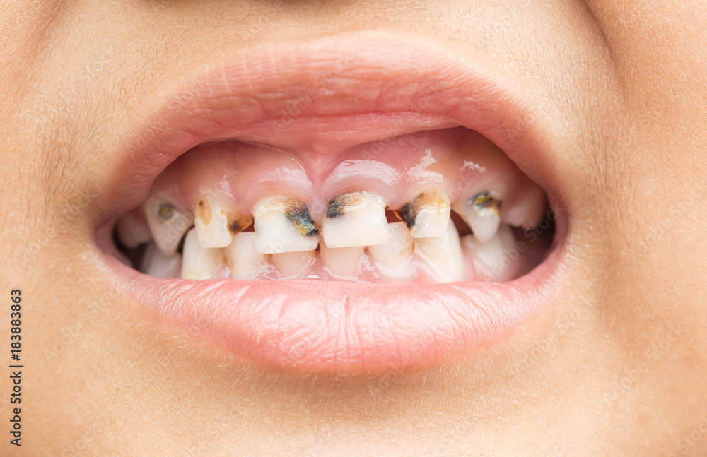 How to prevent cavities and maintain dental wellness