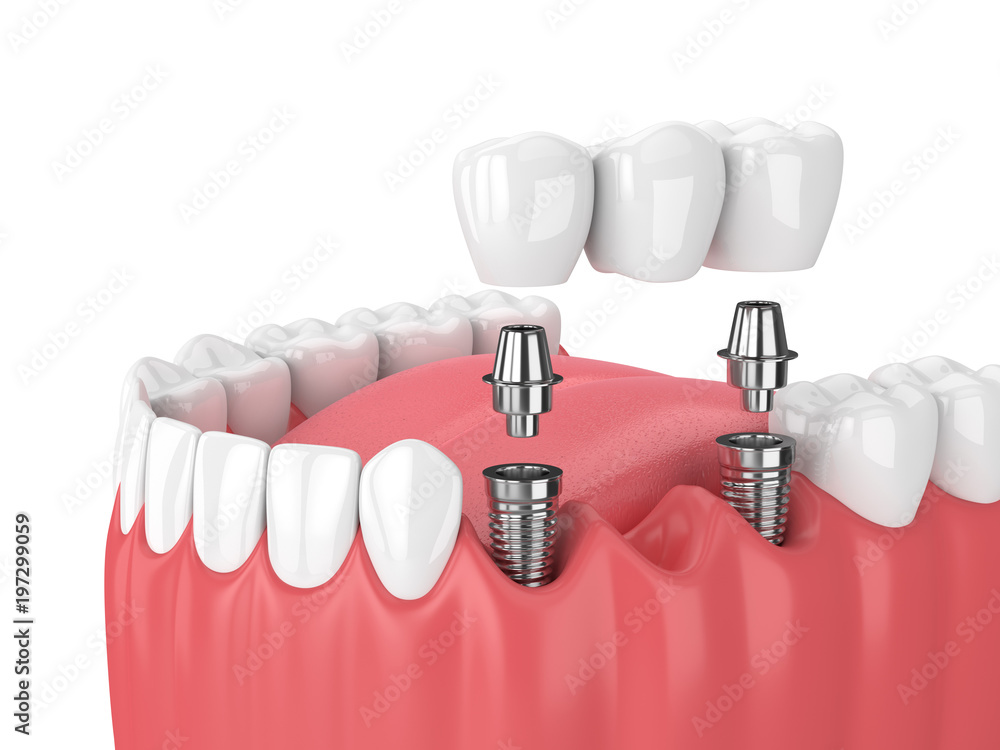 Dental Implants vs Dentures Which Offers Better Value for Money