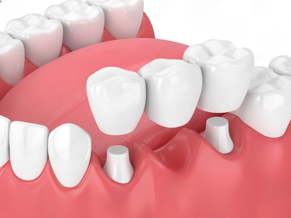 How to care for your dental crown or bridge