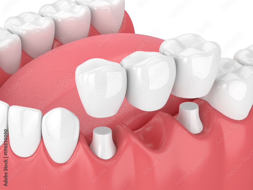 The Benefits of Dental Bridges