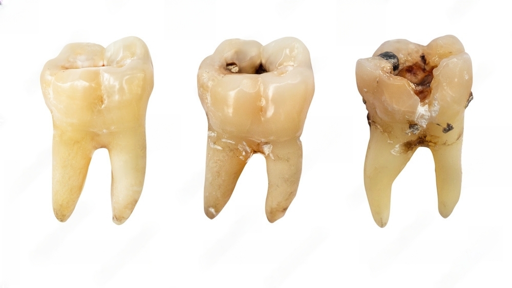 How to Get More Vitamin B5 for Preventing Tooth Decay