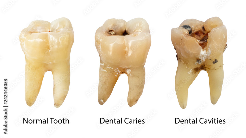 Medications and their impact on the success of dental bonding for stained teeth