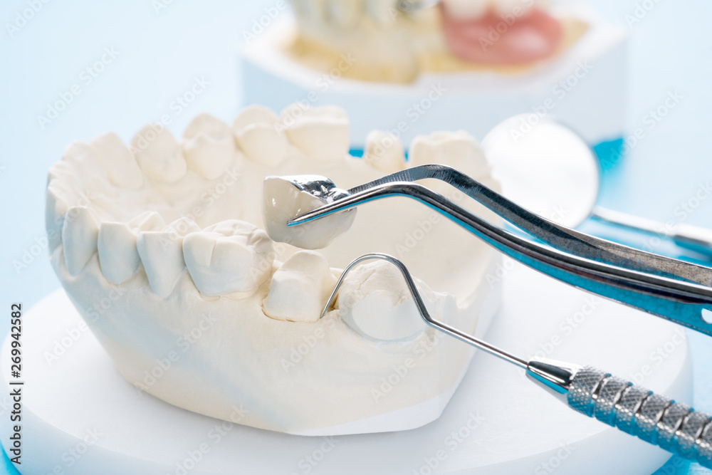 The Benefits of Ceramic Crowns