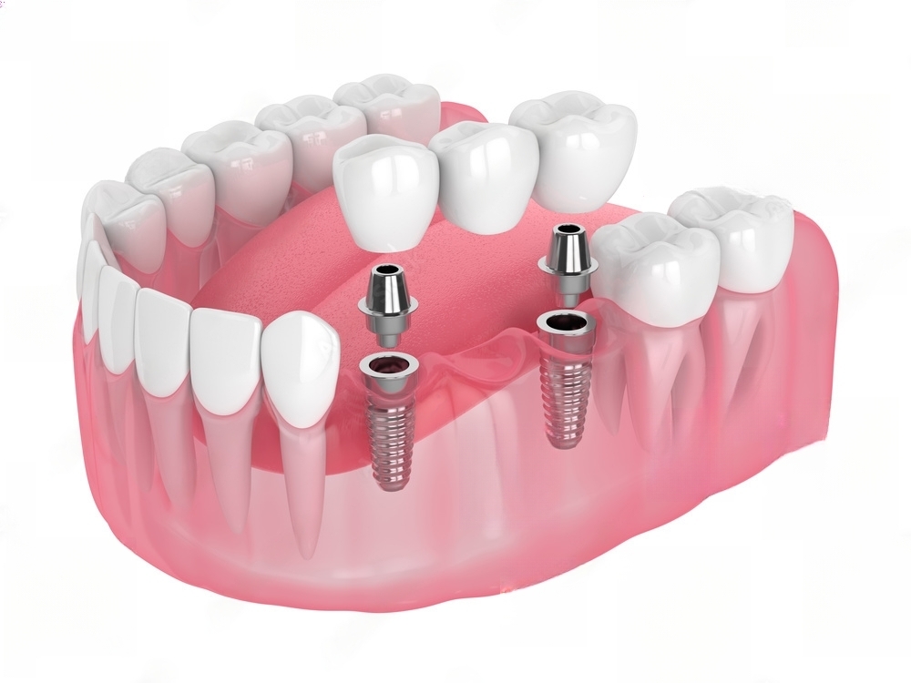 How medications affect dental implants