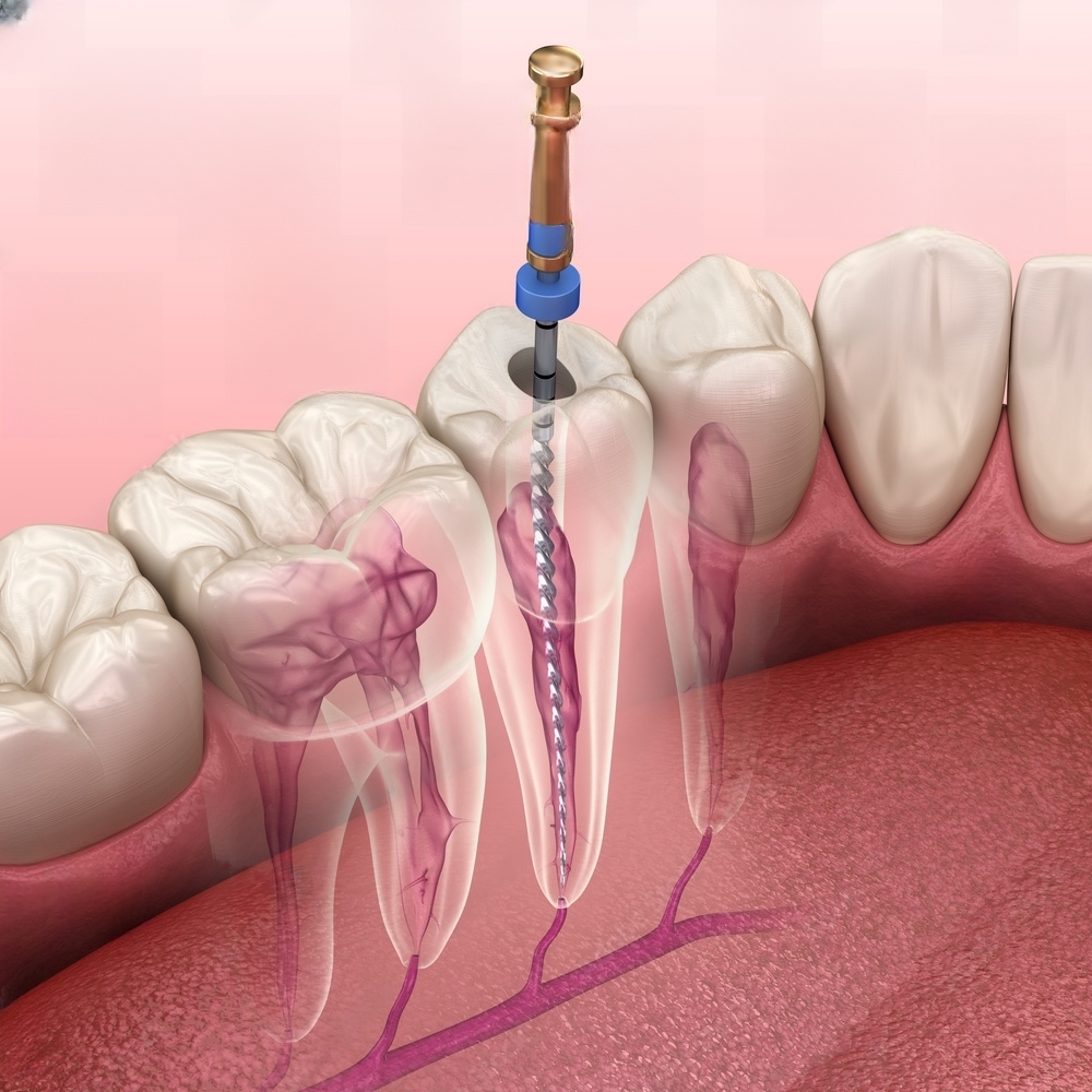 How to maintain dental health with a root canal treatment