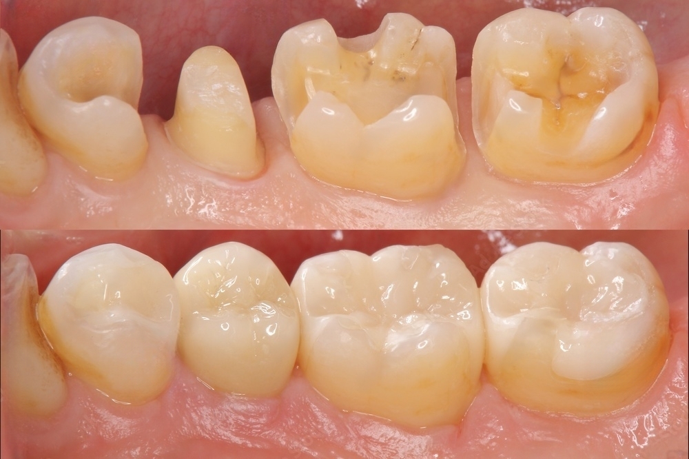 Medications and their impact on the success of tooth colored fillings