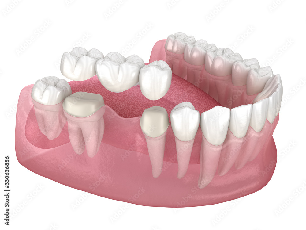 The Benefits of Dental Bridges