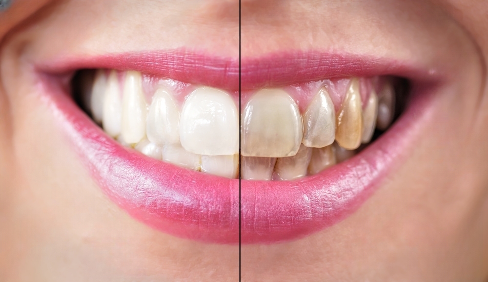 The link between diabetes and tooth discoloration