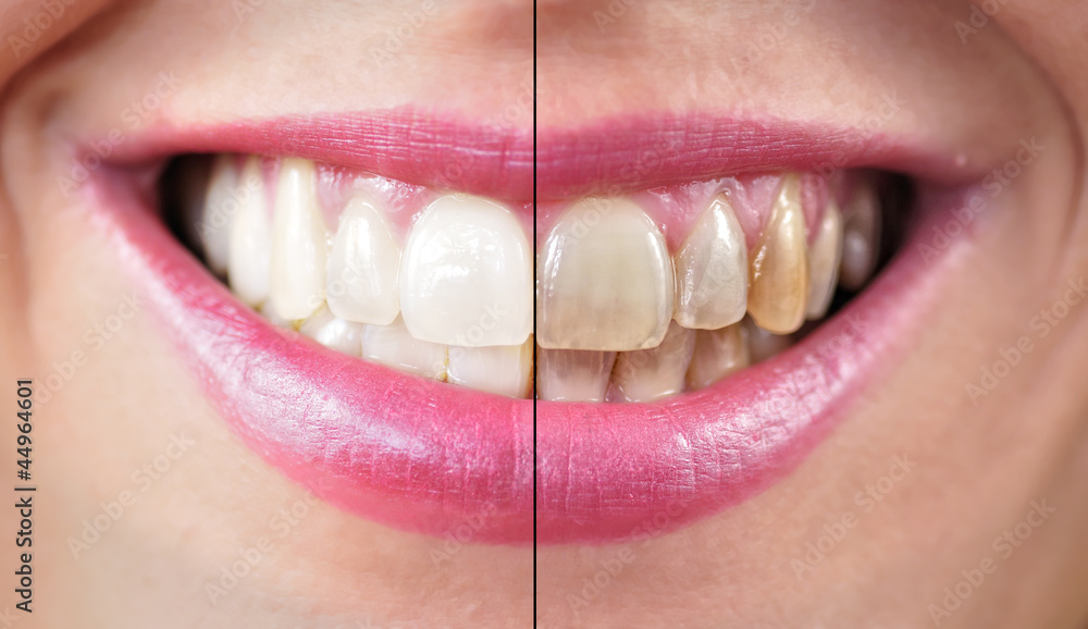 Understanding and managing teeth whitening options