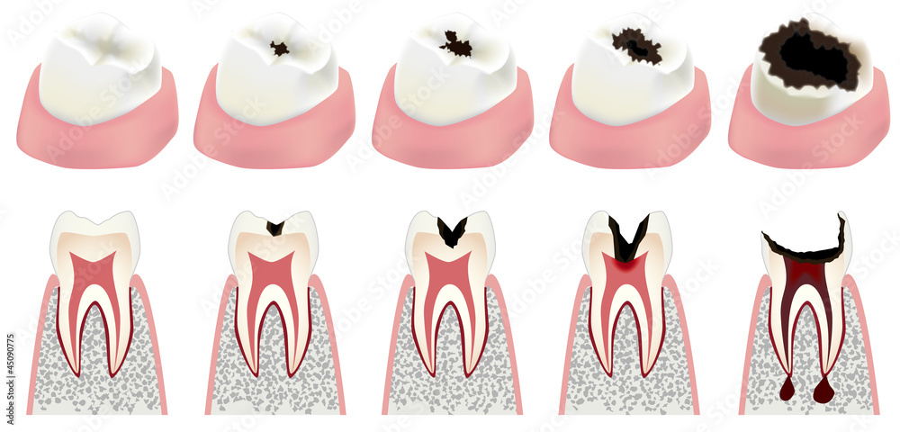 The connection between cavities and overall oral health such as gum disease or tooth decay