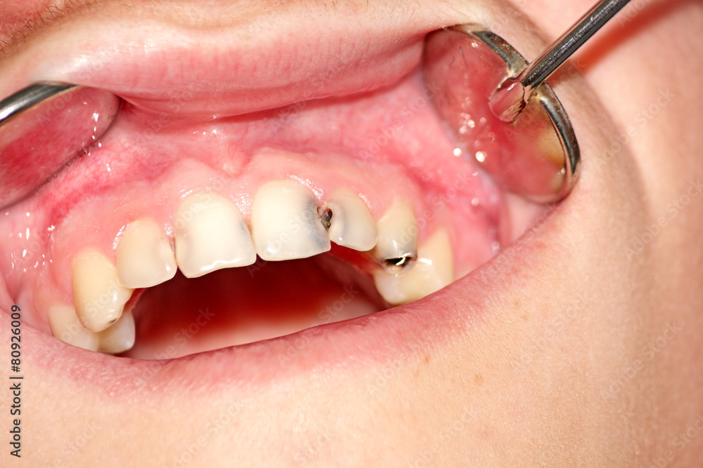 The connection between cavities and overall oral health such as gum disease or tooth decay