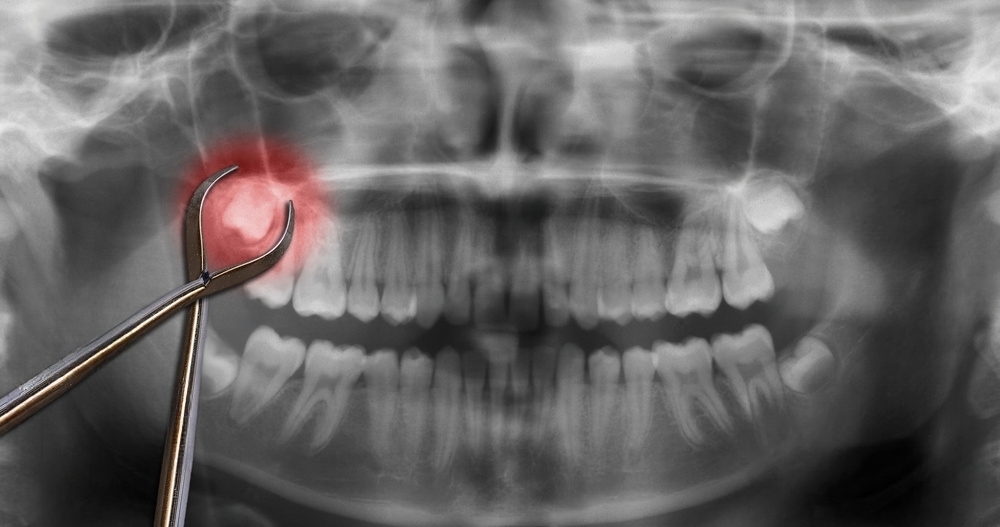 The Importance of Vitamin C for Preventing Gum Recession