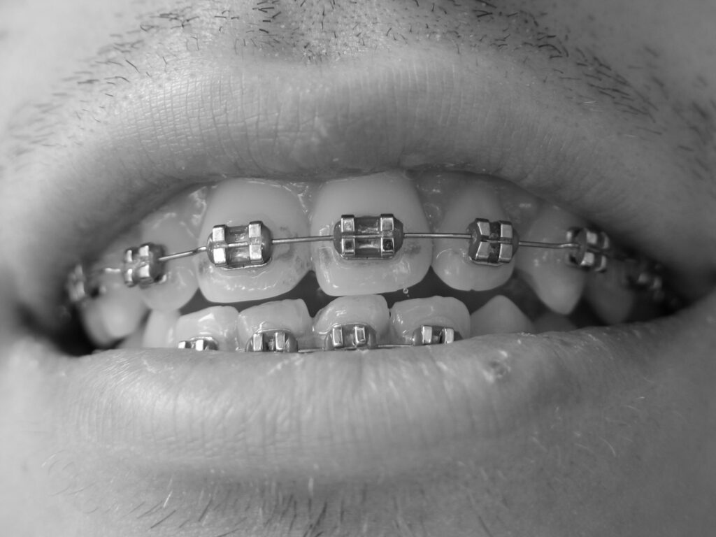 Dental Braces