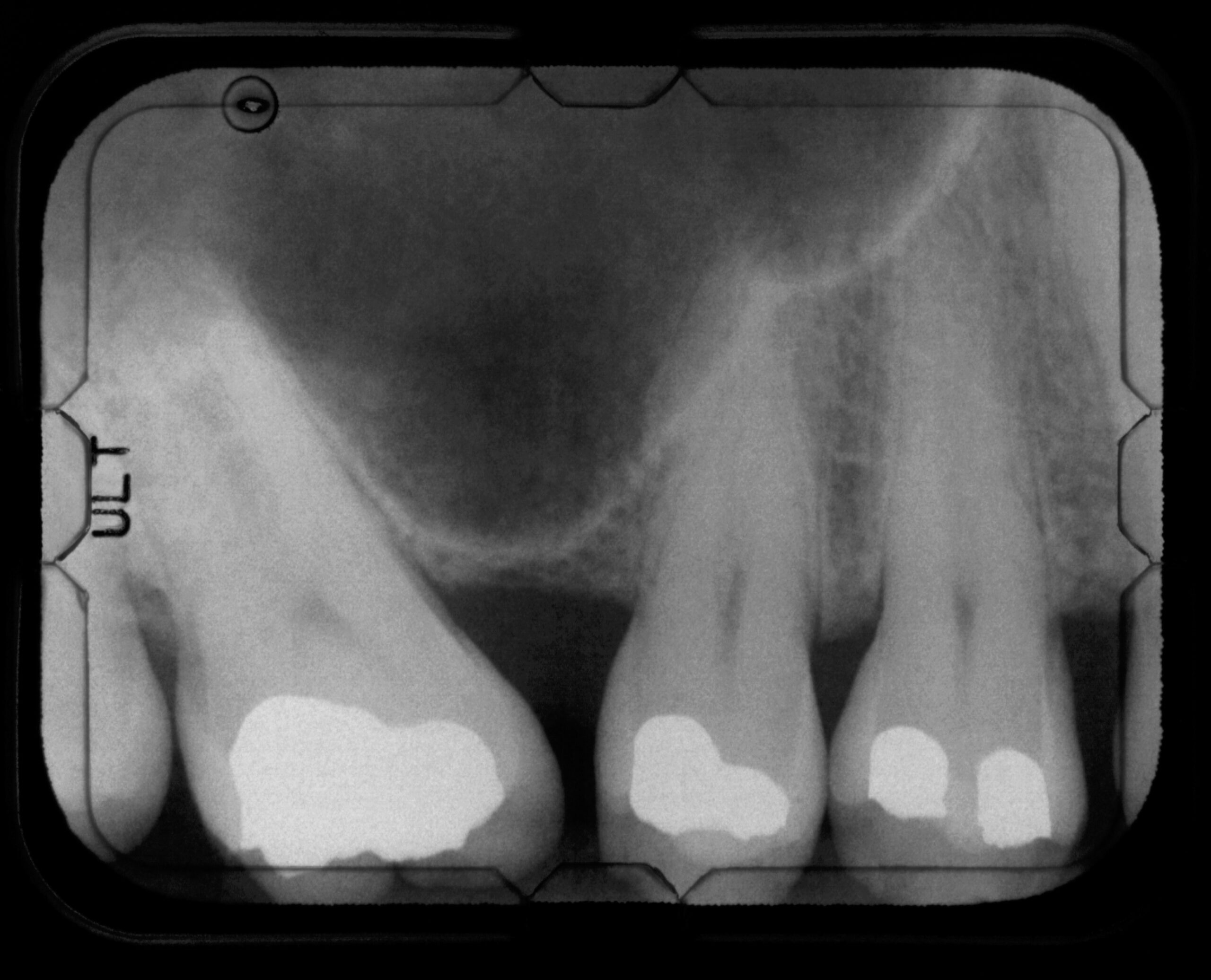 The Advantages of Composite Fillings Over Amalgam Fillings