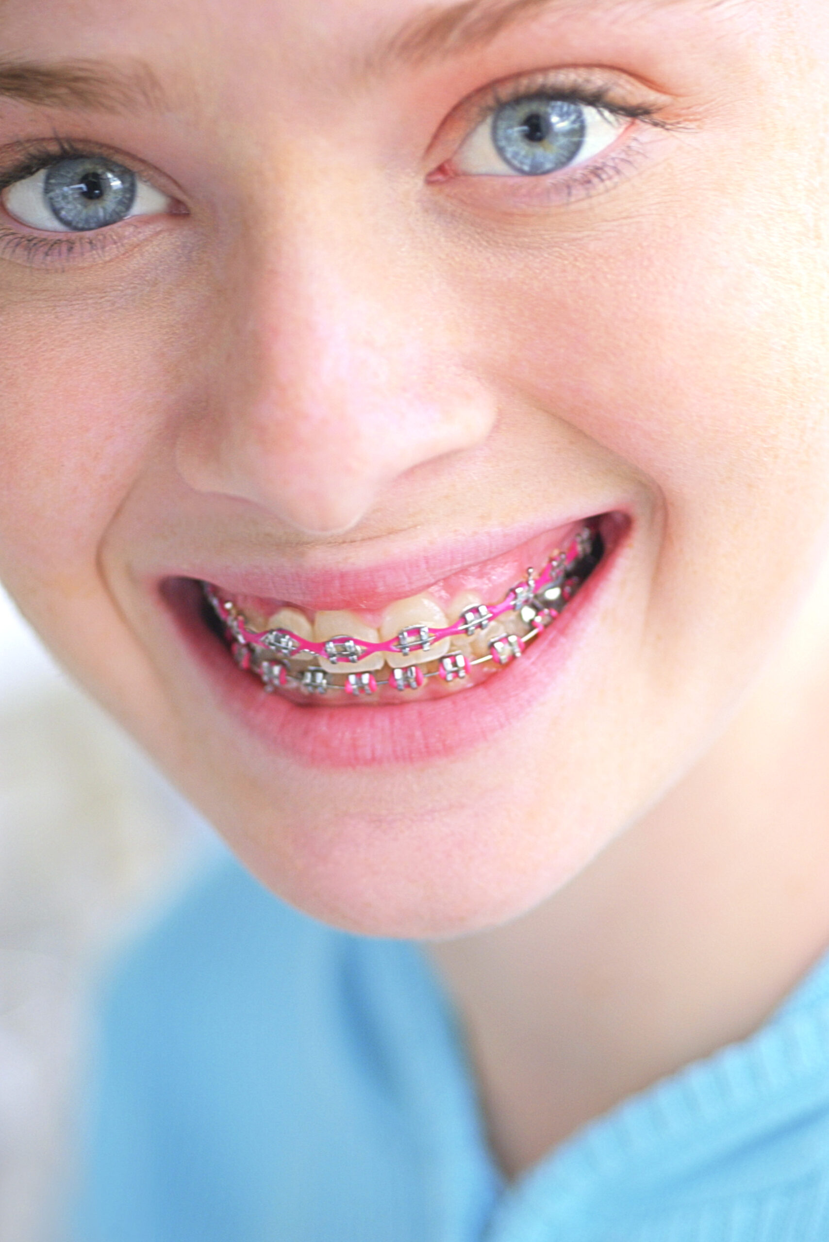 The Benefits of Lingual Braces