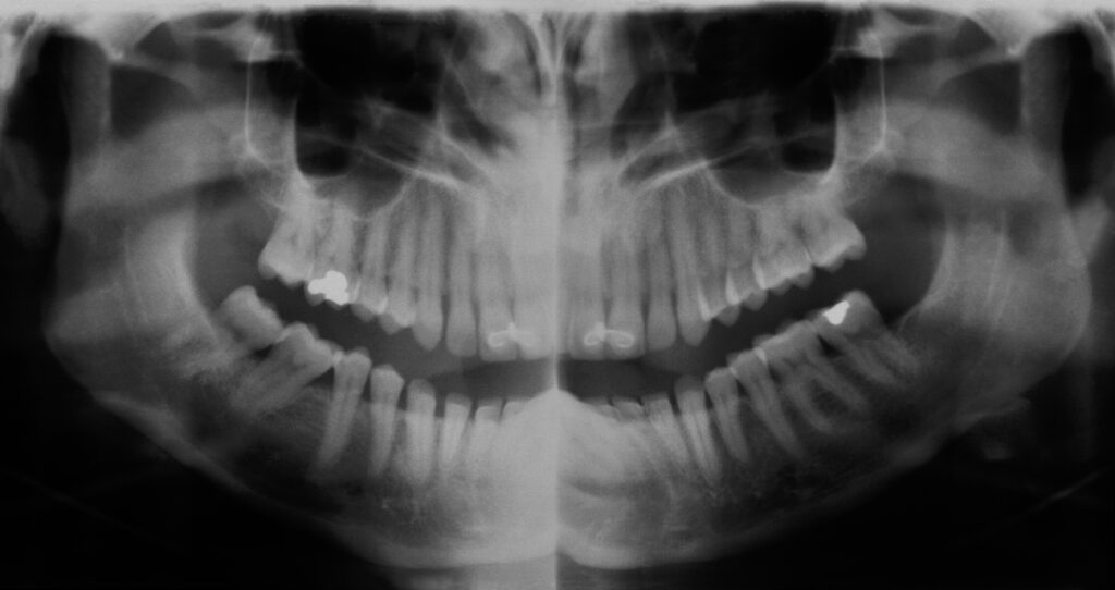 Managing medication use for patients with TMJ pain