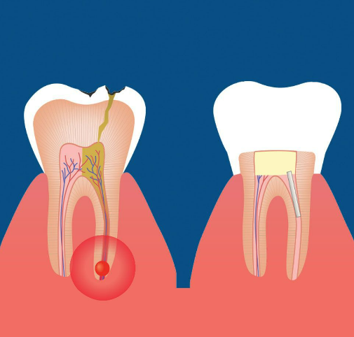 How to maintain dental health with a cracked tooth