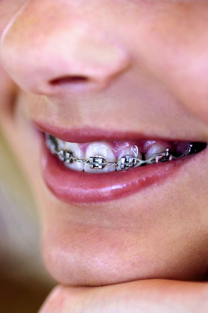 Pregnancy and Braces What You Need to Know