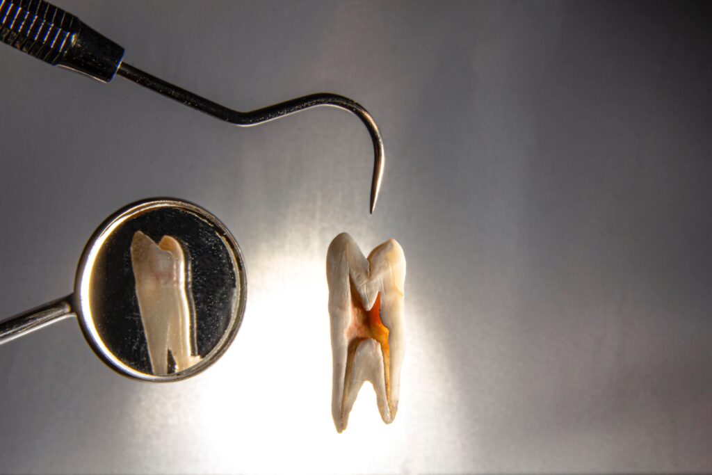 The Cost of Dental Inlays and Onlays