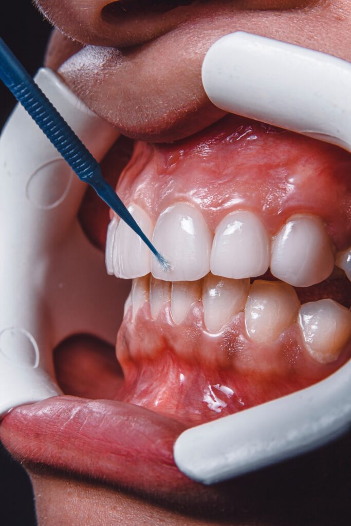 How to Treat and Reverse Gum Disease