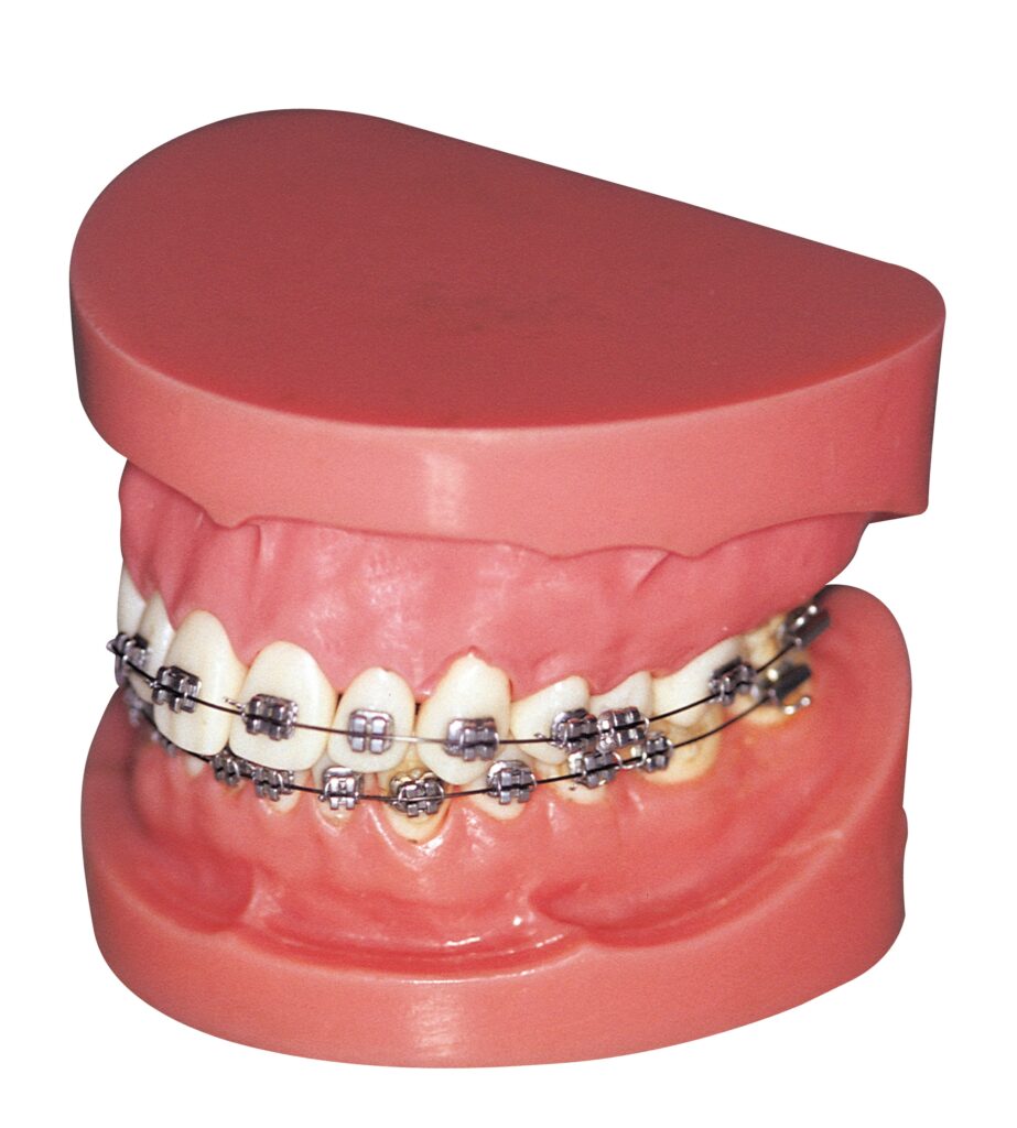 Lingual Braces