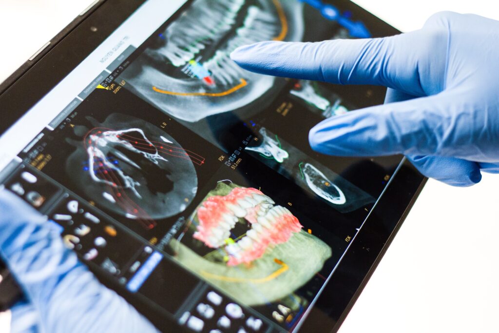 The role of dental X rays in detecting and treating cavities