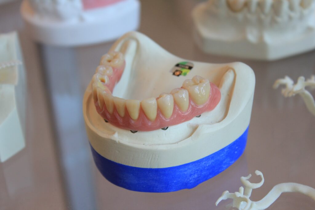 How to care for your teeth after getting a dental bridge supported denture