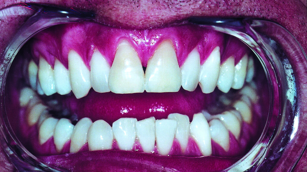 The Pros and Cons of Teeth Whitening