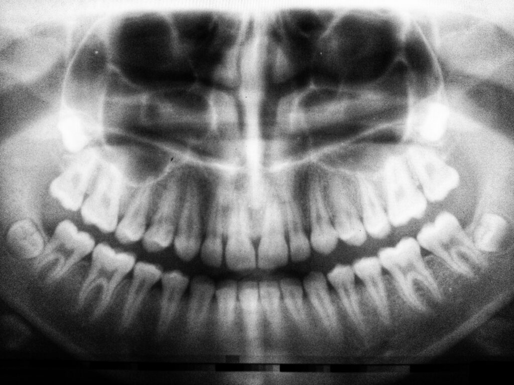 The role of dental X rays in detecting and treating cavities