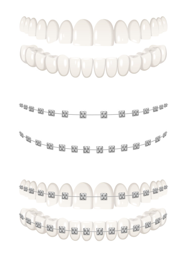 The Connection Between Braces and Heart Disease: What You Need to Know
