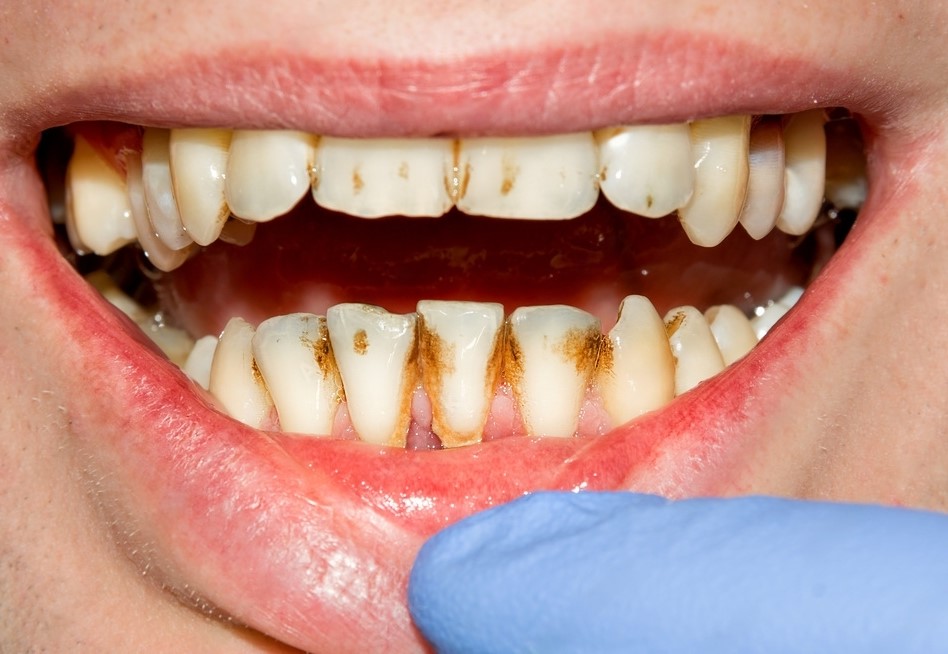 The relationship between diabetes and dental erosion