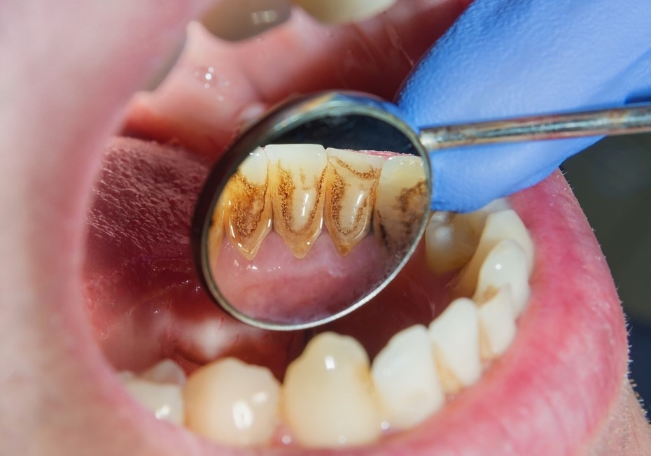 The relationship between diabetes and dental erosion