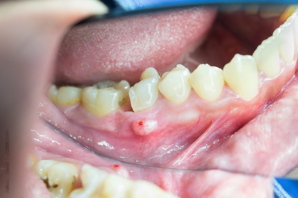 Understanding the connection between diabetes and gum disease