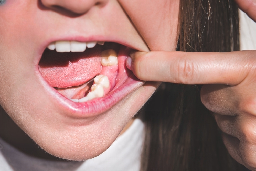 The Link Between Oral Health and Crohn's Disease.