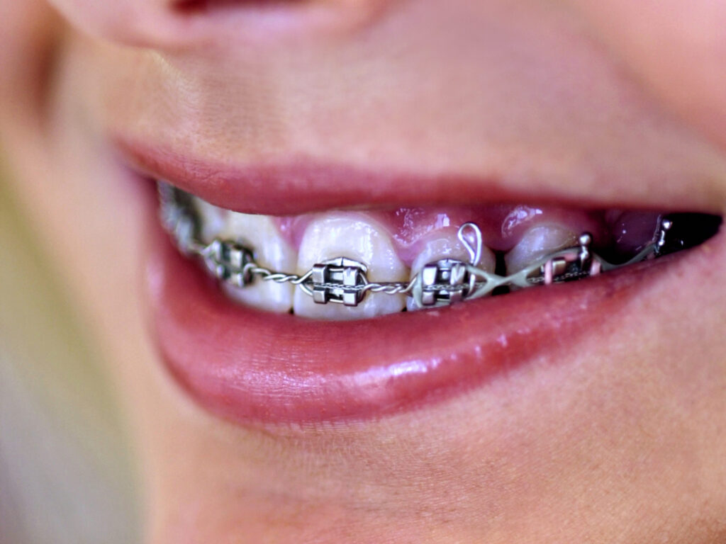 Oral Hygiene Tips for People with Braces