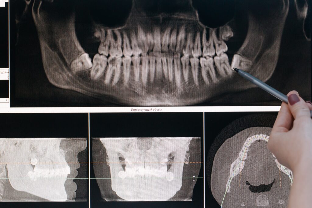 The Connection Between Brushing and Flossing and Osteoporosis